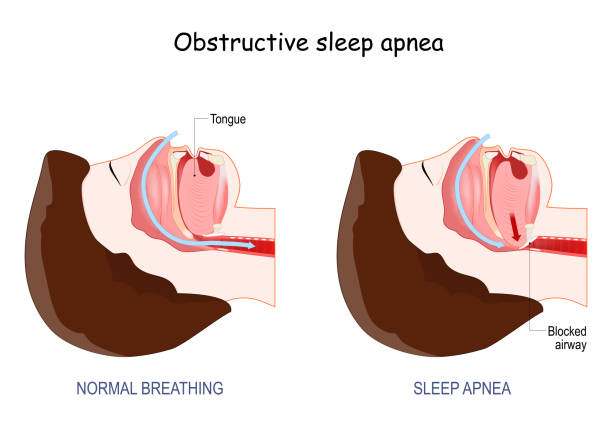 Left panel shows normal breathing with an open airway; right panel shows sleep apnea with a blocked airway caused by the tongue and soft tissues.